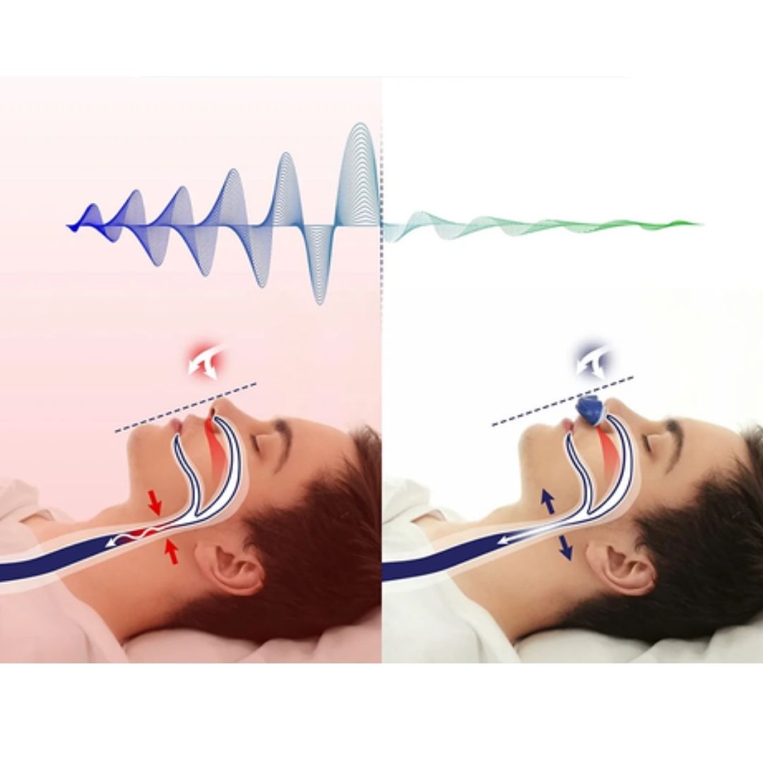 Anti-Schnarchgerät | Drahtloses und maskenfreies Micro-CPAP für besseren Schlaf im Sommer